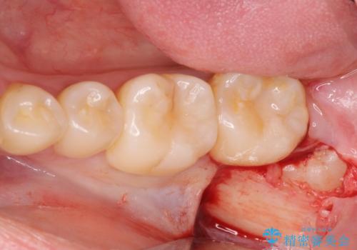 左下の親知らずが腫れた感じがする。の治療中