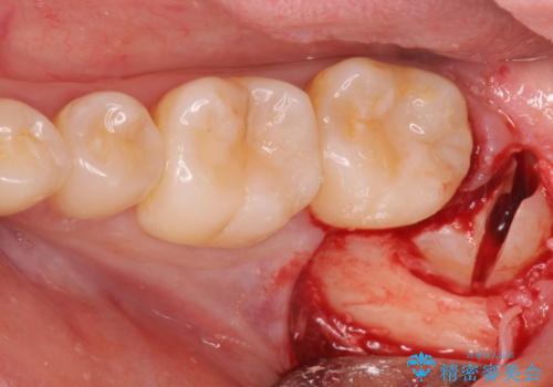 左下の親知らずが腫れた感じがする。の治療中