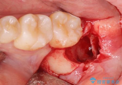 左下の親知らずが腫れた感じがする。の治療中