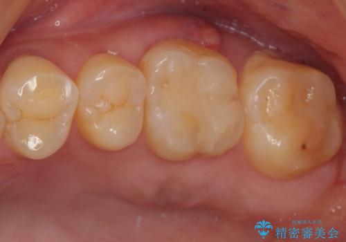 痛みを感じる上顎大臼歯　ゴールドクラウンの補綴治療の治療前