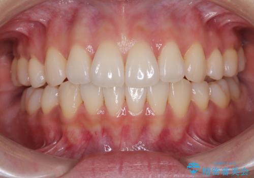 抜歯矯正の軽度後戻りを解消 インビザライン矯正の症例 治療後