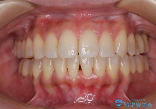 インビザラインによる矯正治療と奥歯のインプラント治療の治療後