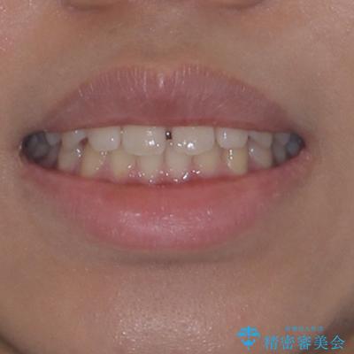 気になるすきっ歯を短期間で改善 インビザライン矯正の治療前(顔貌)