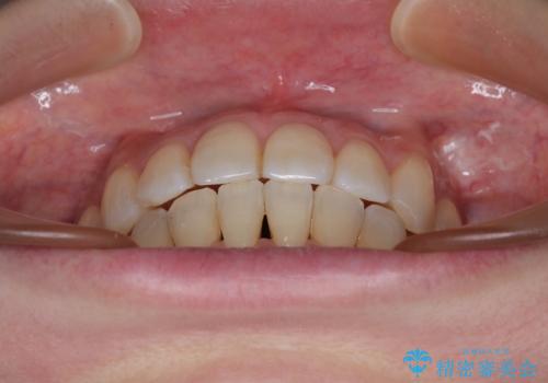 インビザラインによる矯正治療と奥歯のインプラント治療の治療後