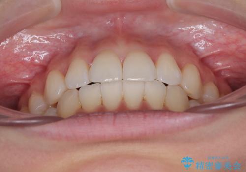 抜歯矯正の軽度後戻りを解消 インビザライン矯正の治療後