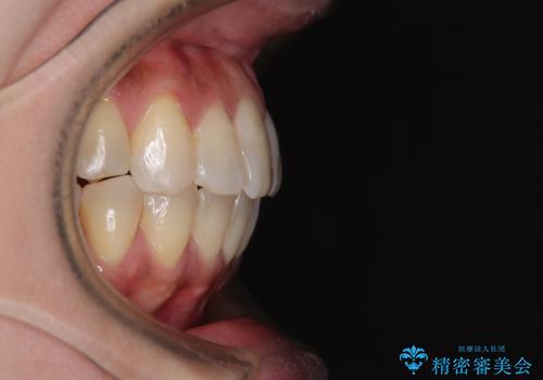 インビザラインによる矯正治療と奥歯のインプラント治療の治療後