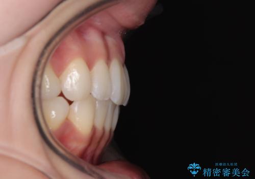 抜歯矯正の軽度後戻りを解消 インビザライン矯正の治療後