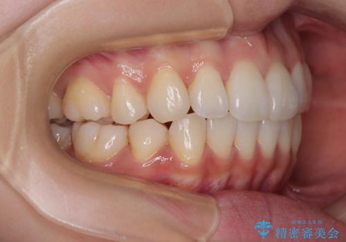抜歯矯正の軽度後戻りを解消 インビザライン矯正の治療後