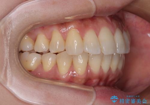 インビザラインによる矯正治療と奥歯のインプラント治療の治療後