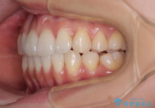 抜歯矯正の軽度後戻りを解消 インビザライン矯正の治療後