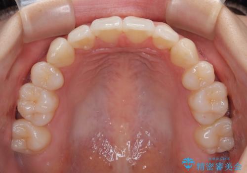抜歯矯正の軽度後戻りを解消 インビザライン矯正の治療後