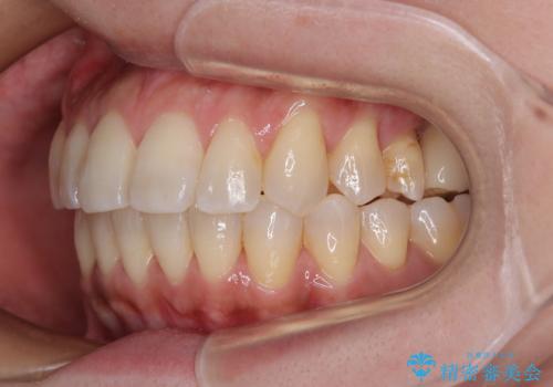 インビザラインによる矯正治療と奥歯のインプラント治療の治療後