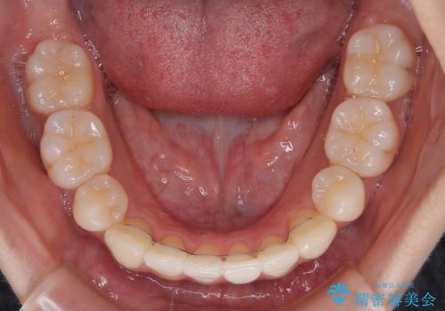 抜歯矯正の軽度後戻りを解消 インビザライン矯正の治療後