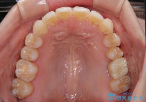 インビザラインによる矯正治療と奥歯のインプラント治療の治療後