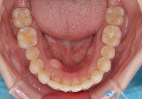 インビザラインによる矯正治療と奥歯のインプラント治療の治療後