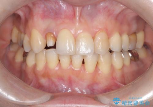 前歯の見た目が気になる|オールセラミッククラウンで見た目を改善の治療中