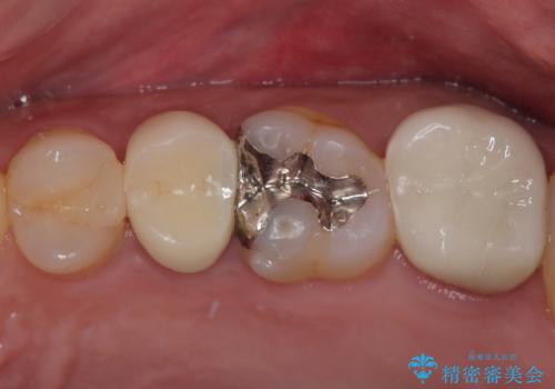 物が詰まる オールセラミッククラウンの治療後