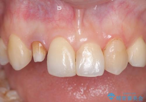 前歯の見た目が気になる|オールセラミッククラウンで見た目を改善の治療中