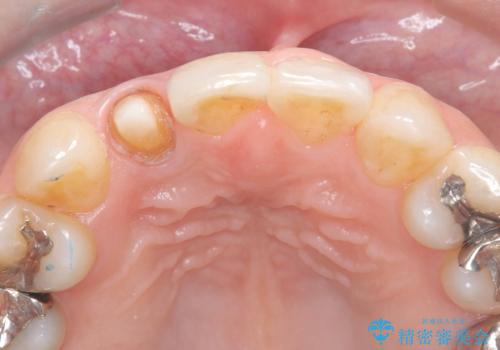 前歯の見た目が気になる|オールセラミッククラウンで見た目を改善の治療中