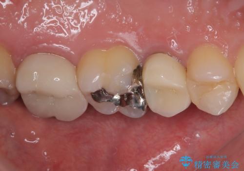 物が詰まる オールセラミッククラウンの治療後