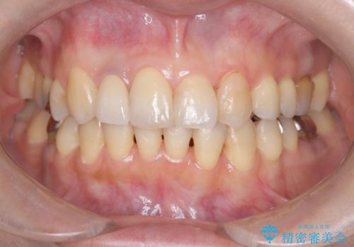 前歯の見た目が気になる|オールセラミッククラウンで見た目を改善の治療後