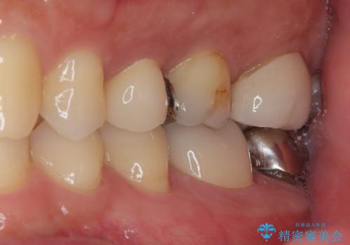 物が詰まる オールセラミッククラウンの治療後