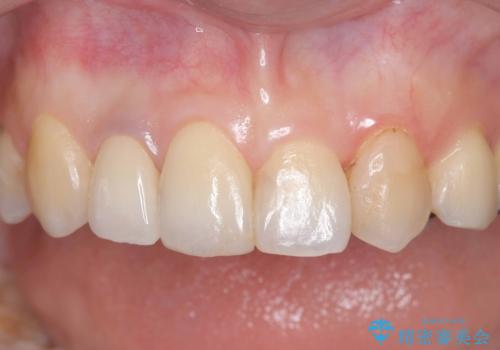 前歯の見た目が気になる|オールセラミッククラウンで見た目を改善の症例 治療後