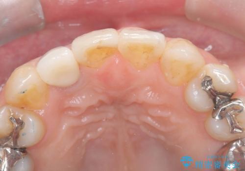 前歯の見た目が気になる|オールセラミッククラウンで見た目を改善の治療後