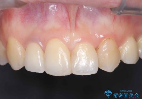 前歯の見た目が気になる|オールセラミッククラウンで見た目を改善の治療後