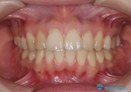 後戻りをインビザラインでスッキリした口元にの症例 治療前