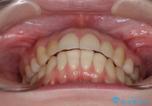 後戻りをインビザラインでスッキリした口元にの治療前