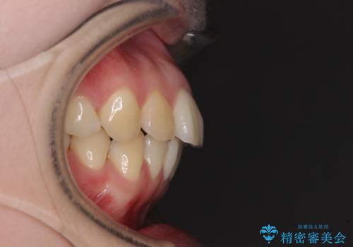 後戻りをインビザラインでスッキリした口元にの治療前