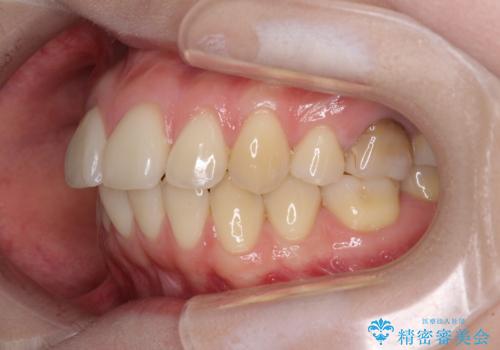 後戻りをインビザラインでスッキリした口元にの治療前