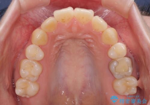 後戻りをインビザラインでスッキリした口元にの治療前