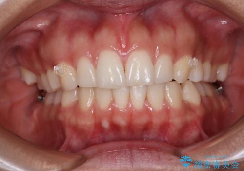 【モニター】突出した前歯 補助装置を併用したインビザライン矯正の治療中