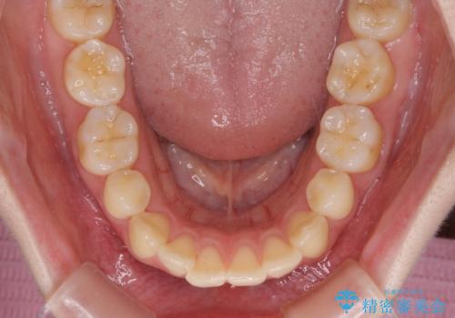 後戻りをインビザラインでスッキリした口元にの治療前