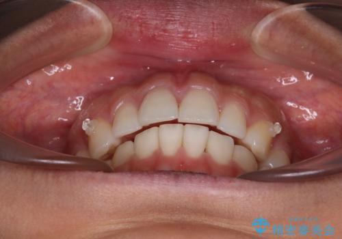 【モニター】突出した前歯 補助装置を併用したインビザライン矯正の治療中