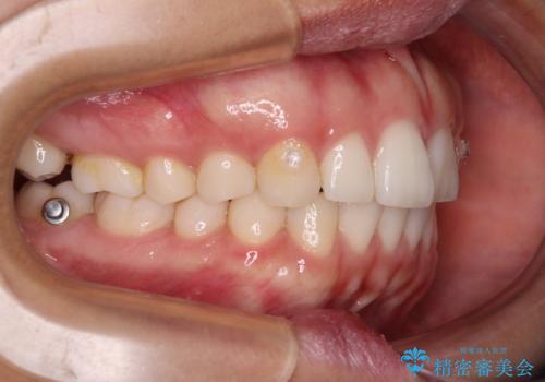 【モニター】突出した前歯 補助装置を併用したインビザライン矯正の治療中