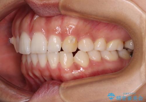 【モニター】突出した前歯 補助装置を併用したインビザライン矯正の治療中