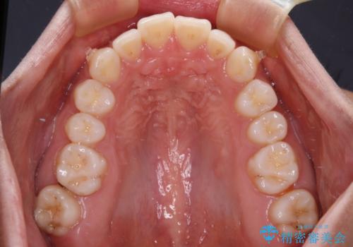 【モニター】突出した前歯 補助装置を併用したインビザライン矯正の治療中