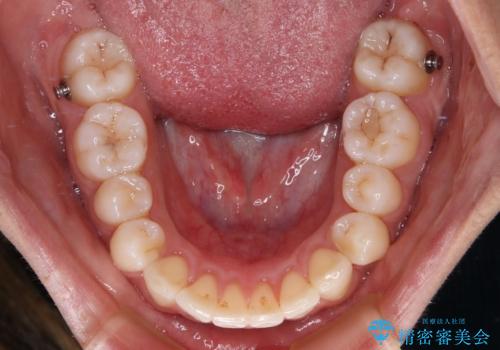 【モニター】突出した前歯 補助装置を併用したインビザライン矯正の治療中