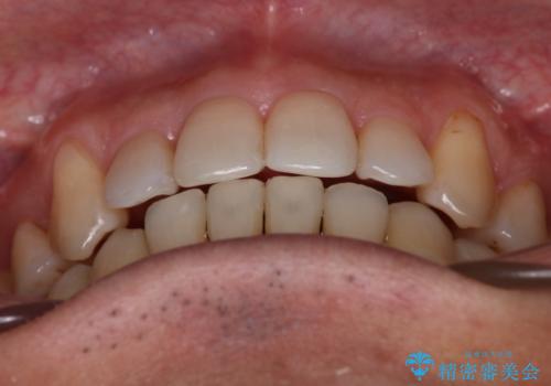 【クリア装置】がたつきを治したいの治療後