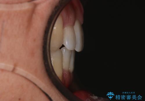 【クリア装置】がたつきを治したいの治療後