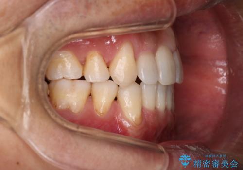 【クリア装置】がたつきを治したいの治療後