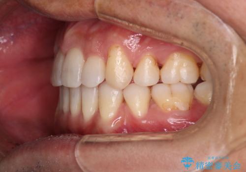 【クリア装置】がたつきを治したいの治療後