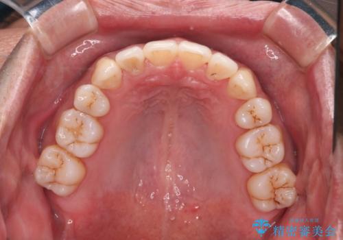 【クリア装置】がたつきを治したいの治療後