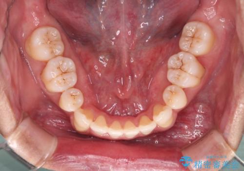 【クリア装置】がたつきを治したいの治療後