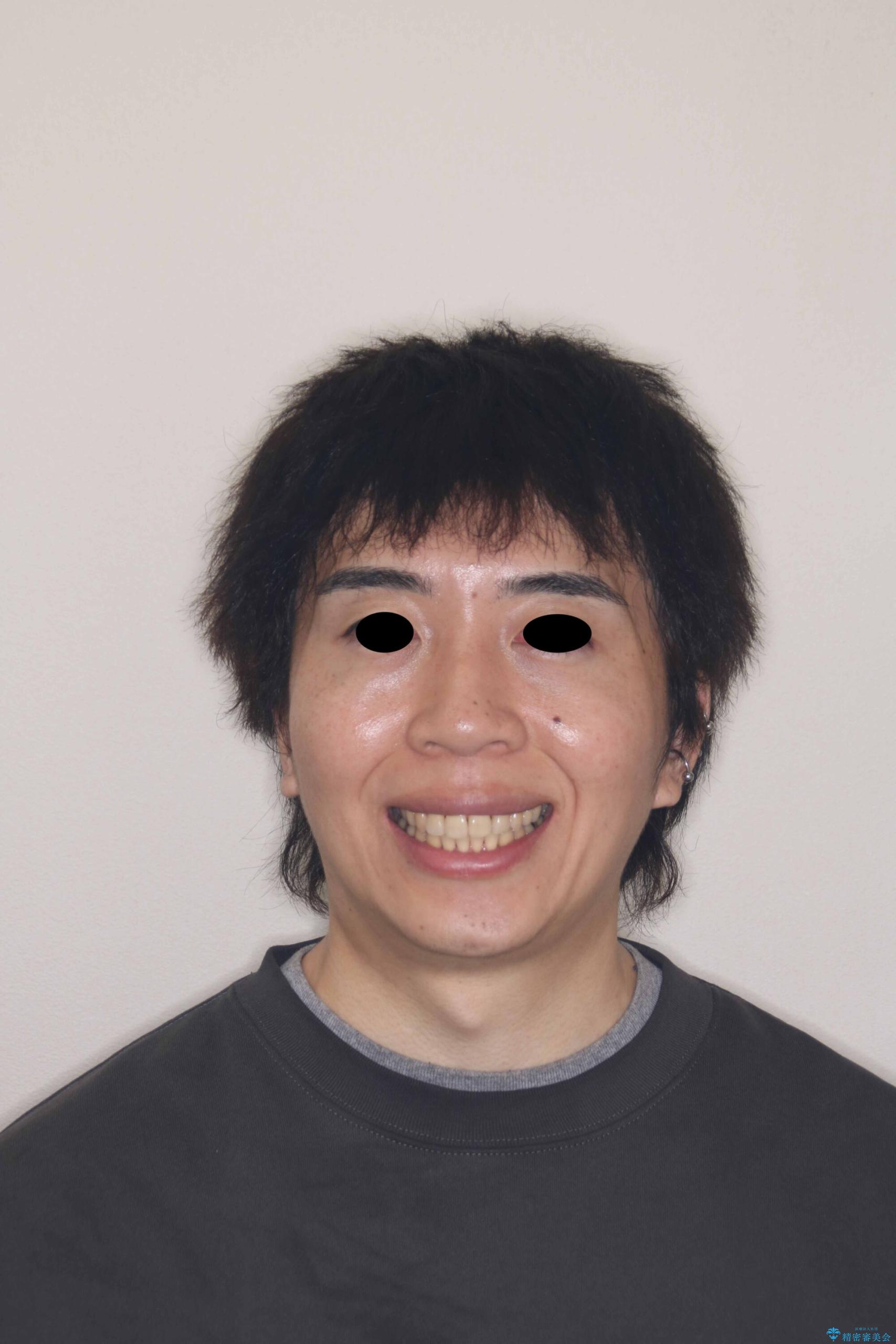 モニター|歯のでこぼこと前歯が引っ込んでいるのを治したい|抜歯矯正で歯のデコボコと正中を改善|ワイヤー矯正の治療後(顔貌)