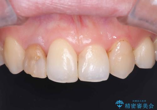 前歯の見た目が気になる|オールセラミッククラウンで見た目を改善