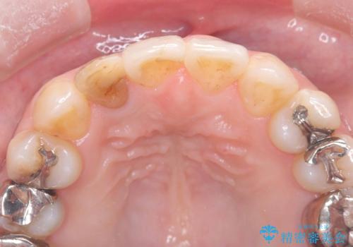 前歯の見た目が気になる|オールセラミッククラウンで見た目を改善の治療前